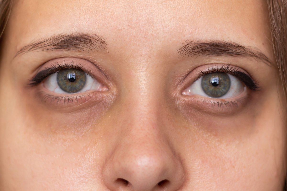 How to Prevent Dark Circles?